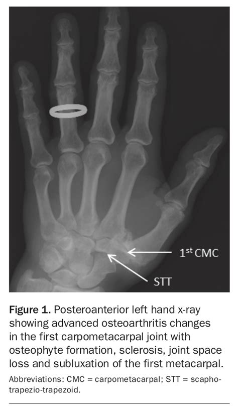 Taking a grip of thumb osteoarthritis | Medicine Today