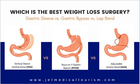 Gastric Sleeve vs Bypass vs Lap Band: Which is Best Weight Loss Surgery