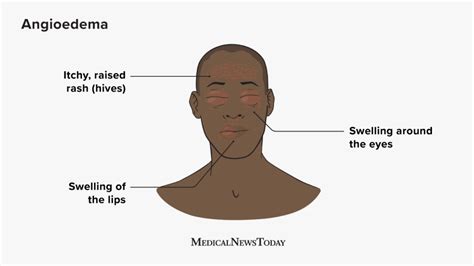 Angioedema and hives: Symptoms, causes, and treatment