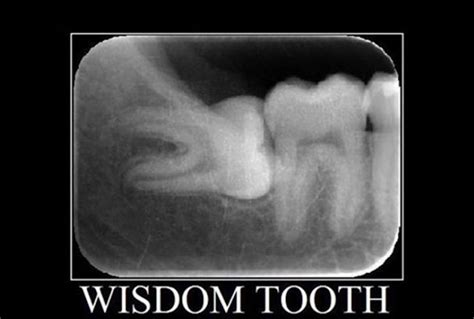 Impacted Wisdom Tooth and Pericoronitis