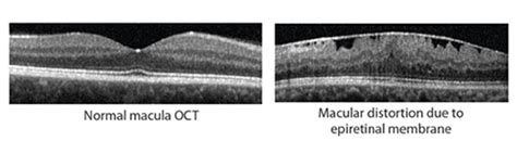 Epiretinal Membrane - Fraser Eye Care Center