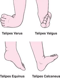 CLUB FOOT (OR) CTEV-CONGENITAL TALIPES EQUINO VARUS