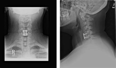 Cervical Herniated Disc New York City | Spinal Nerve Compression NYC