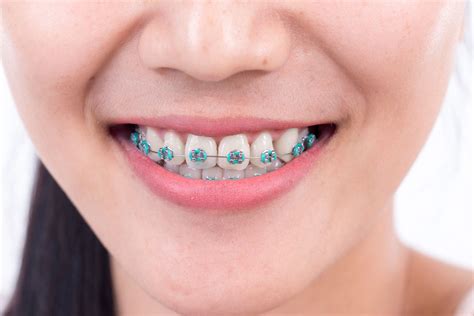 The Purpose of Elastic Ligatures on Braces