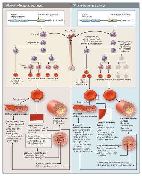 Hydroxyurea for the Treatment of Sickle Cell Anemia | NEJM