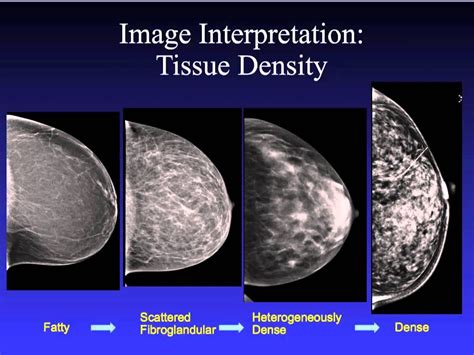 Introduction to Mammography | Mammography, Mammogram, Medical ultrasound