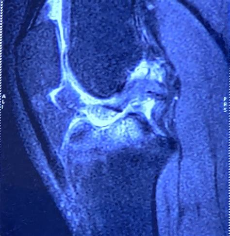 [Figure, Tibial Eminence Fracture Magnetic Resonance...] - StatPearls ...