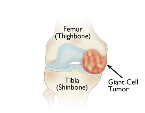 Giant Cell Tumor of Bone - OrthoInfo - AAOS