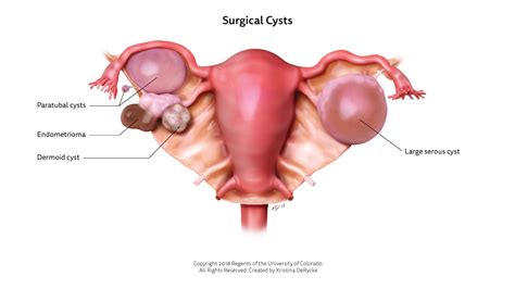 Ovarian Cyst Rupture: Pain Symptoms From Burst Cyst, 41% OFF