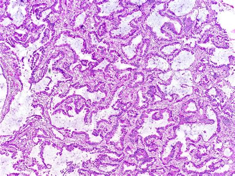 Lung Carcinoma Histology