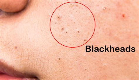 Blackheads: Causes, Symptoms, Prevention and Treatment - HealthyLopo