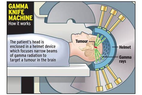 Scheme of gamma knife treatment is... - Gamma Knife Center Indonesia ...