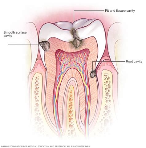 Types of cavities - Mayo Clinic