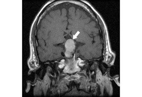 Pituitary Tumor Mri