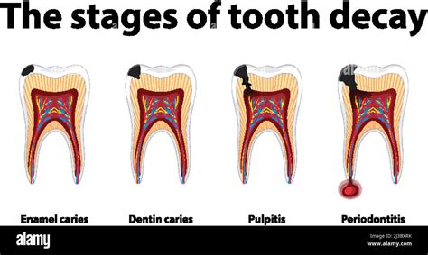 Vector Illustration Of Tooth Decay Four Stages Of Dental Caries | The ...