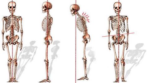 Spinal Deformities - Dr. Paul C. McCormick