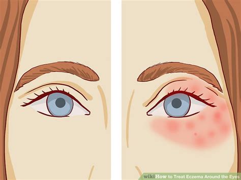 How to Treat Eczema Around the Eyes (with Pictures) - wikiHow