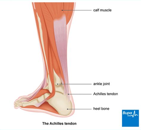 Achilles Tendinopathy: Symptoms, Causes and Treatment | Bupa UK