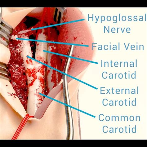 Carotid Endarterectomy Shunt