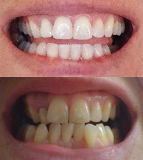 Invisalign Before & After Video Update – My Invisalign Blog