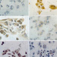 Immunoreactivity of the original tumor for neuroendocrine markers. (a ...