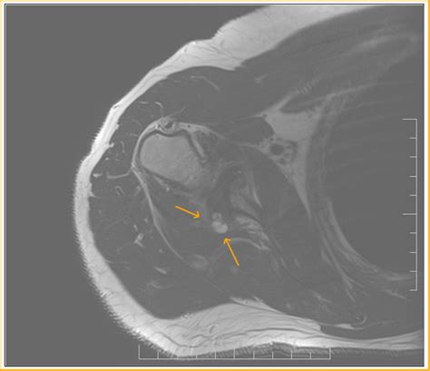 Reverse Hill Sachs Lesion: MRI - Sumer's Radiology Blog