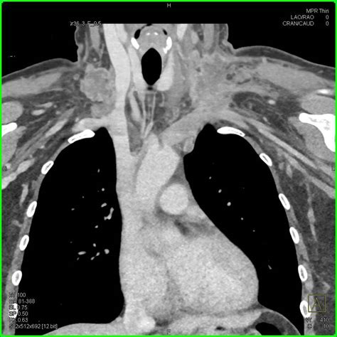 Supraclavicular Nodes