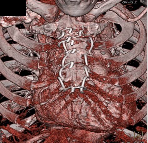 Sternal Wires Following Medial Sternotomy - Chest Case Studies - CTisus ...