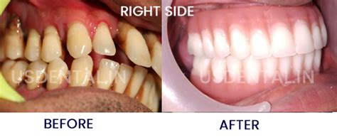 What is the best treatment option for a loose tooth? | US Dental