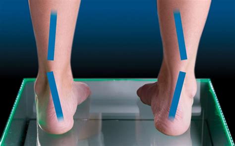 Supination of the foot: Causes and treatment