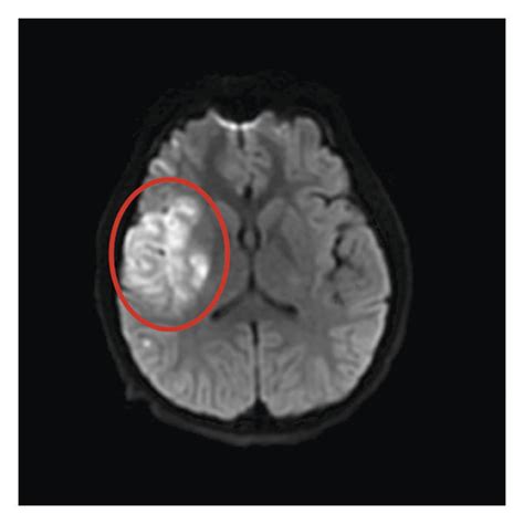 Diffusion weighted imaging (DWI) sequence demonstrating restricted ...