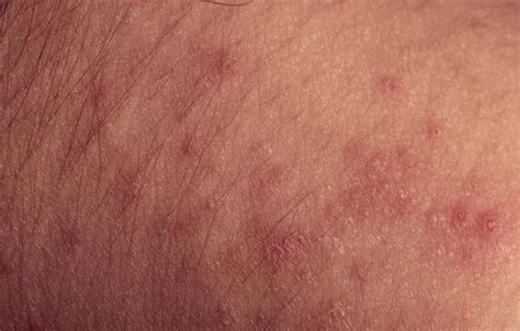 Sugar allergy rash pictures | Symptoms and pictures