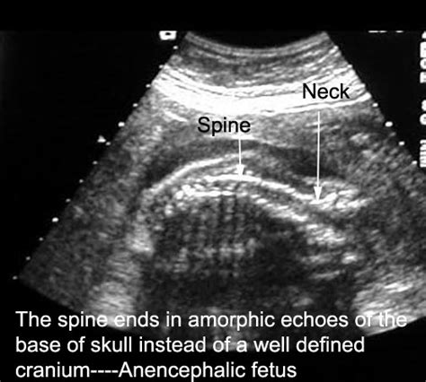 Anencephaly