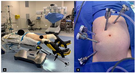 SciELO - Brasil - Technical essential aspects in robotic colorectal ...