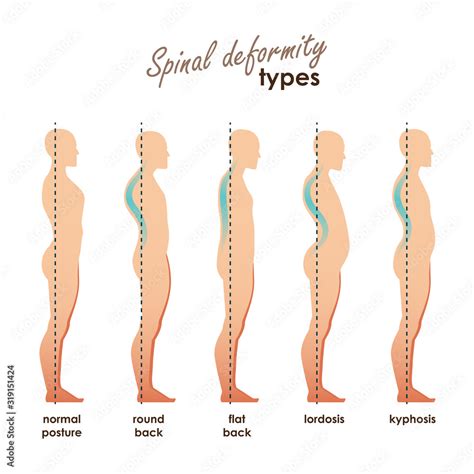 Spinal deformity types. Diseases of the spine.Lordosis, kyphosis, round ...