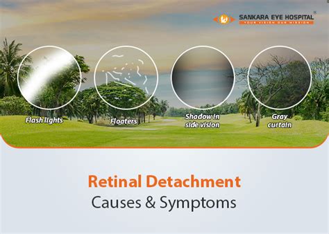 Retinal Detachment Symptoms | Sankara Eye Foundation