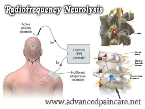 If #identified as such, then the procedure of #Radiofrequency # ...