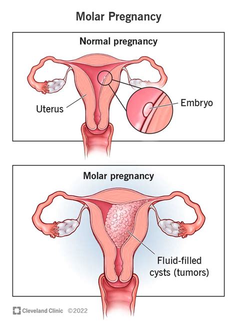 Molar Pregnancy Symptoms – asnachicago