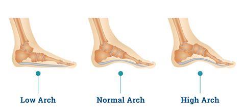 Know Your Arches - ShoeInsoles.co.uk