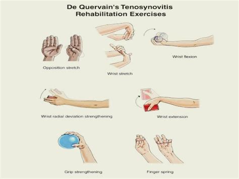 De quervain's disease,what to know?