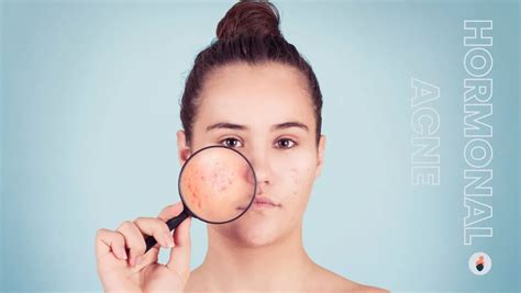 Hormonal Acne Guide - Types, Causes, Treatment & more | ELARA CARE