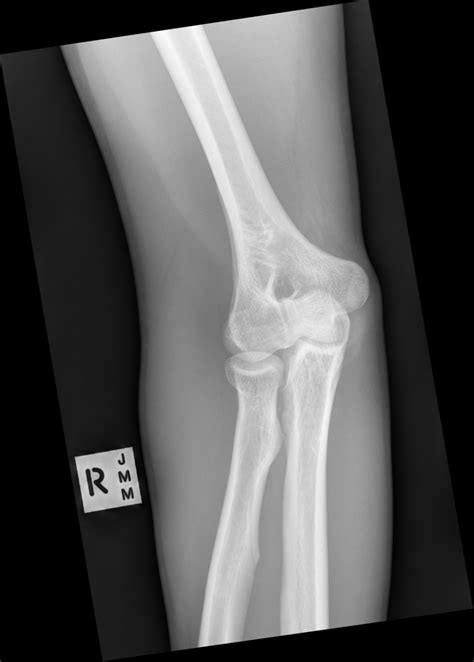 EMRad: Radiologic Approach to the Pediatric Traumatic Elbow X-ray