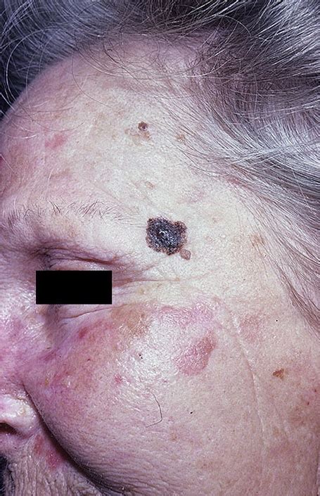 Melanoma on Face Pictures – 22 Photos & Images / illnessee.com