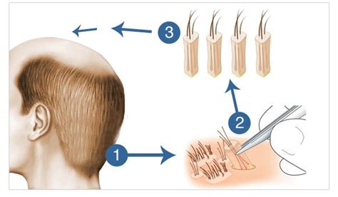 FUE (Follicular Unit Extraction) - Rejuvenate Med