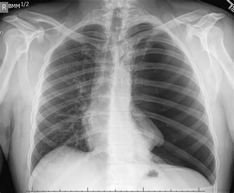 Mild Pneumothorax X Ray