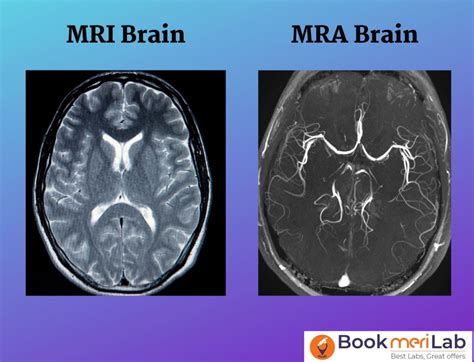 MRI Angiography Price, Purpose, Procedure, Results [2024]