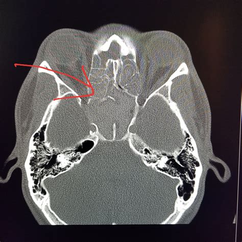 #Head #CT shows severe #sinusitis with the sinuses completely blocked ...