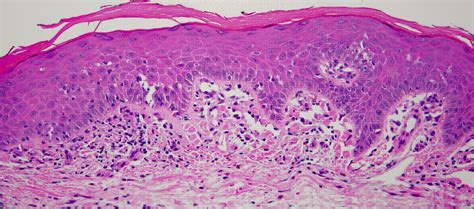 Mycosis Fungoides Histology