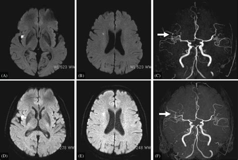 MRI/MRA performed on the following day (A to C) and five days (D to F ...