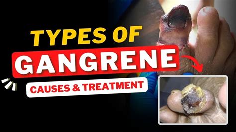 Gangrene | Types of gangrene | Causes and Homeopathic Treatment - YouTube